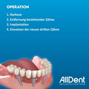 Hinweise Post-Op bei der feste dritte Zähne-Behandlung