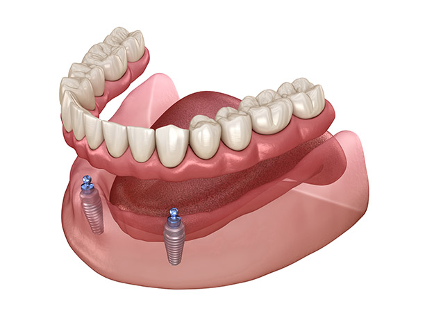 Visualisierung Overdenture Druckknopf (Unterkiefer auf zwei Implantaten)